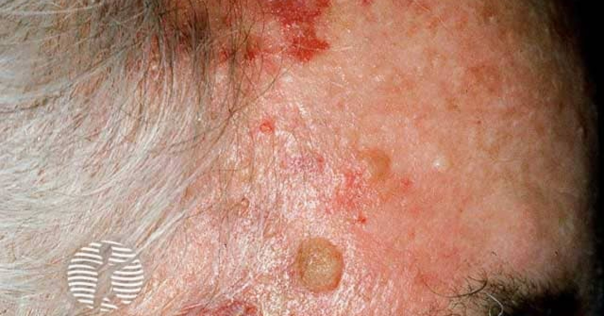 Clinical image of Cutaneous angiosarcoma