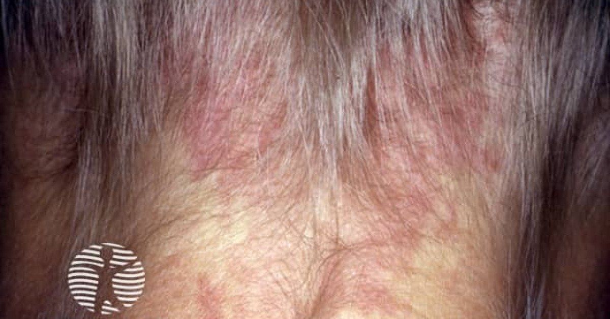 Clinical image of Cutaneous AVM