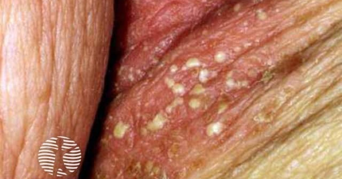 Clinical image of Cutaneous candidiasis