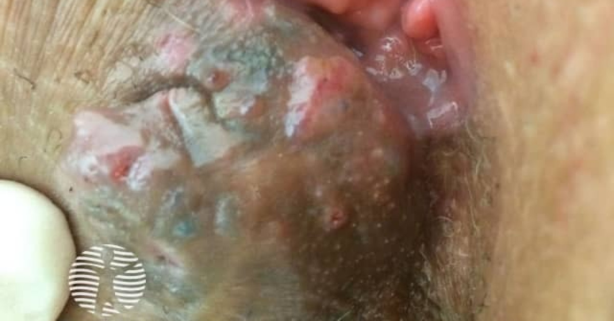 Clinical image of Cutaneous endometriosis