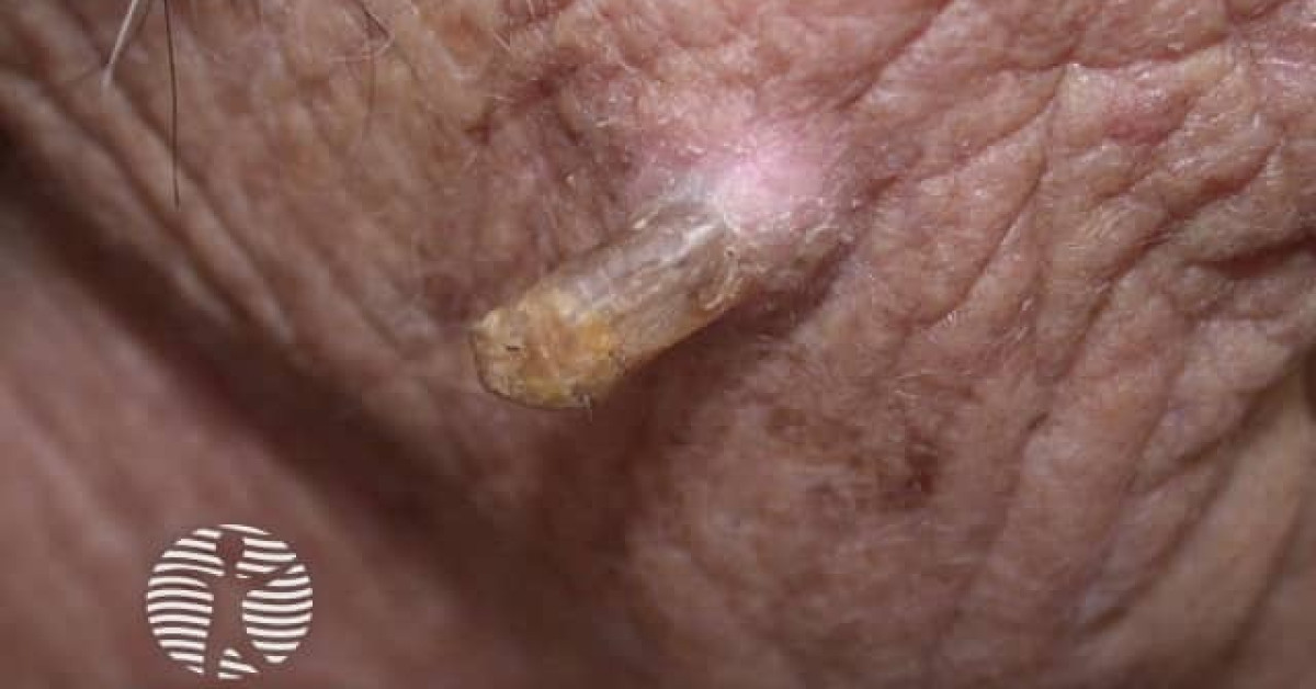 Clinical image of Cutaneous horn