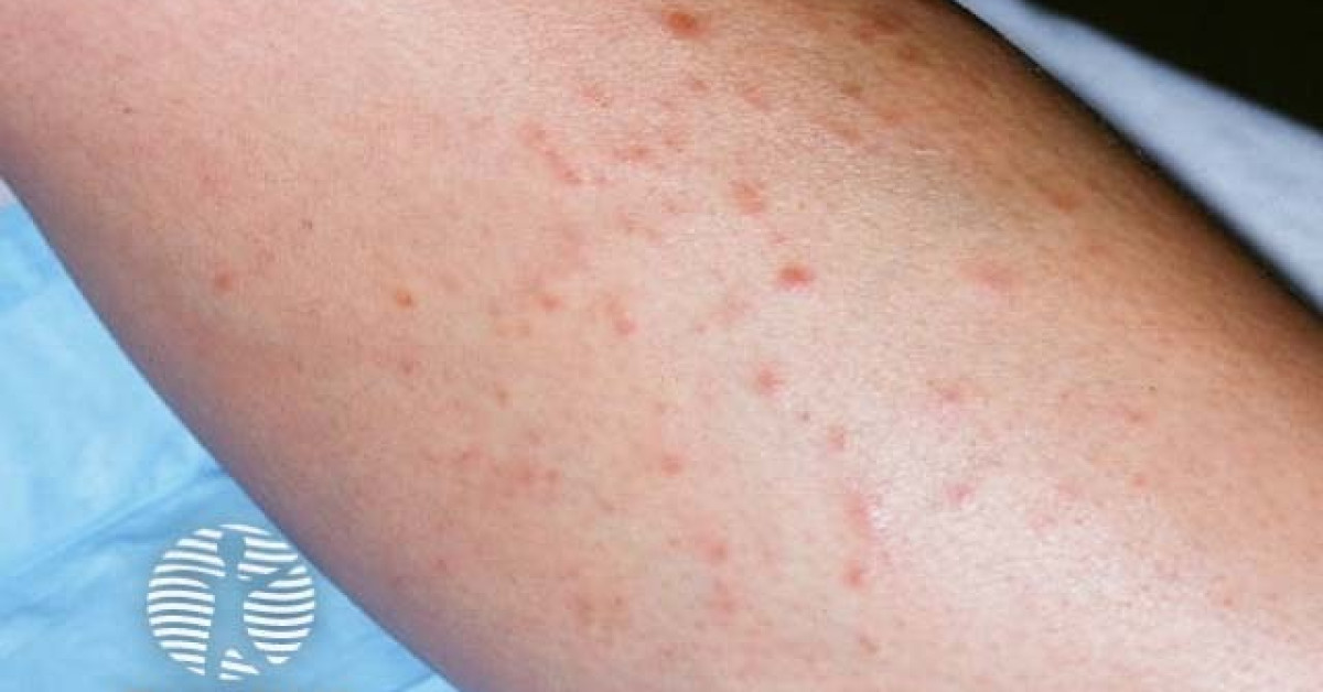 Clinical image of Cutaneous leiomyoma