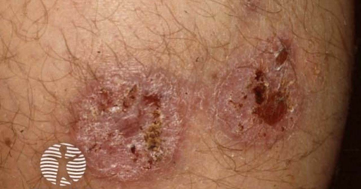 Clinical image of Cutaneous leishmaniasis
