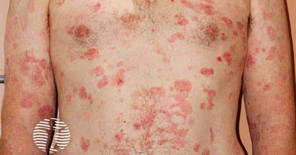Clinical image of Cutaneous T-cell lymphoma