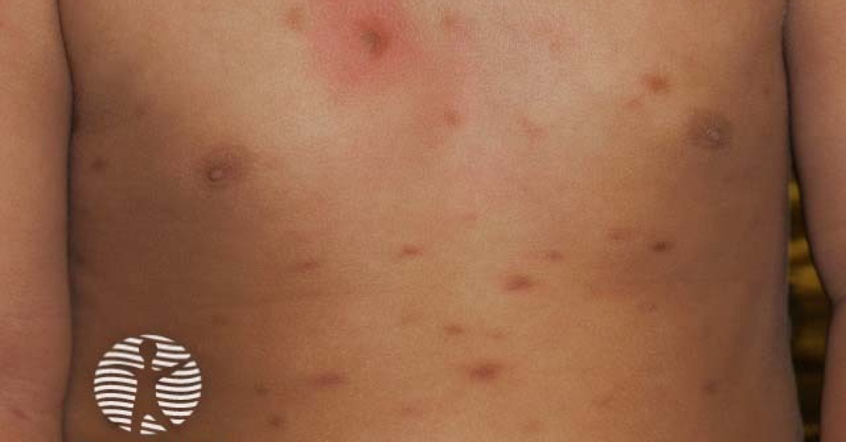 Clinical image of Cutaneous mastocytosis
