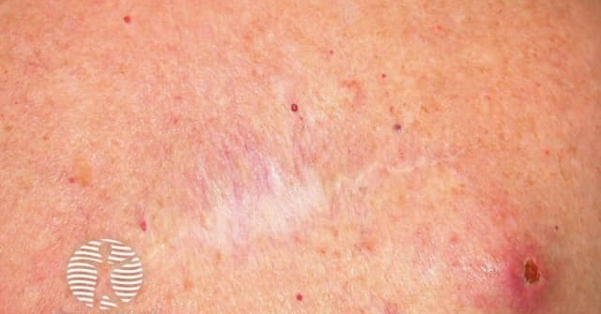 Clinical image of Cutaneous metastases