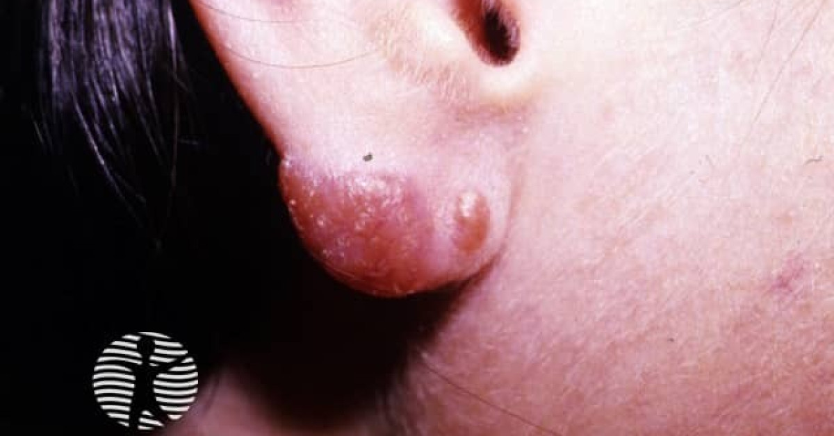 Clinical image of Cutaneous tuberculosis
