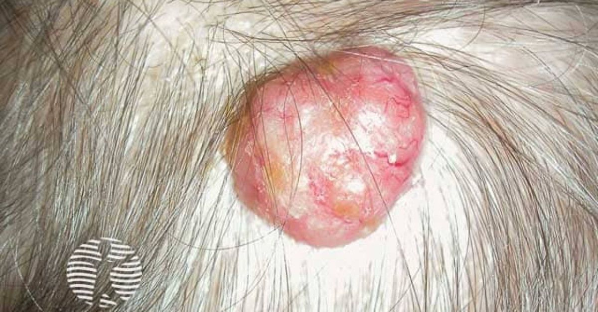 Clinical image of Cylindroma