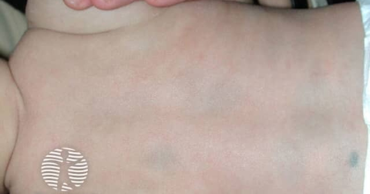 Clinical image of Dermal melanocytosis (Mongolian spot)