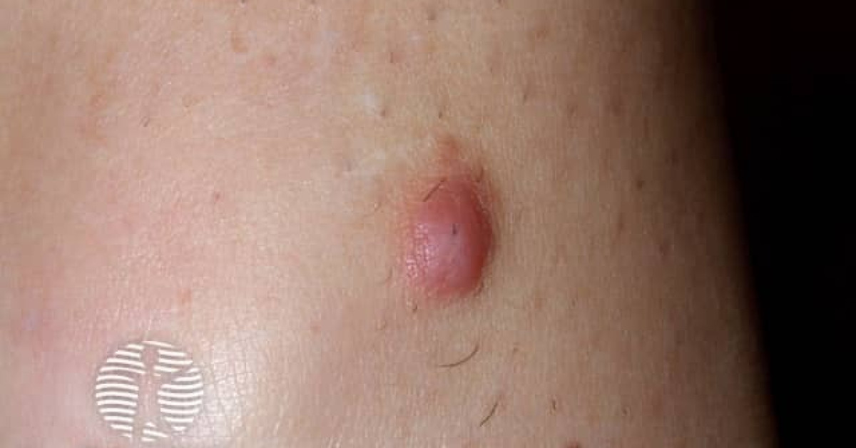 Clinical image of Dermatofibroma
