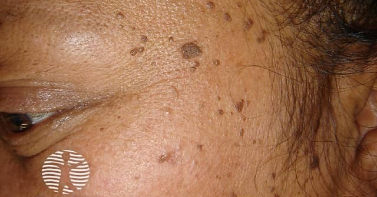Clinical image of Dermatosis papulosa nigra
