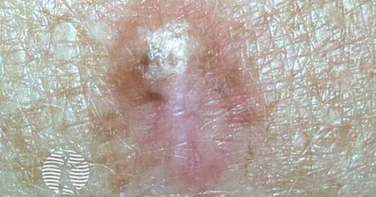 Clinical image of Desmoplastic melanoma