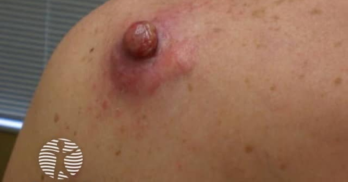 Clinical image of Dermatofibrosarcoma protuberans