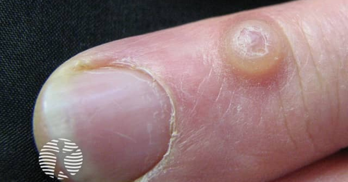 Clinical image of Digital myxoid cyst