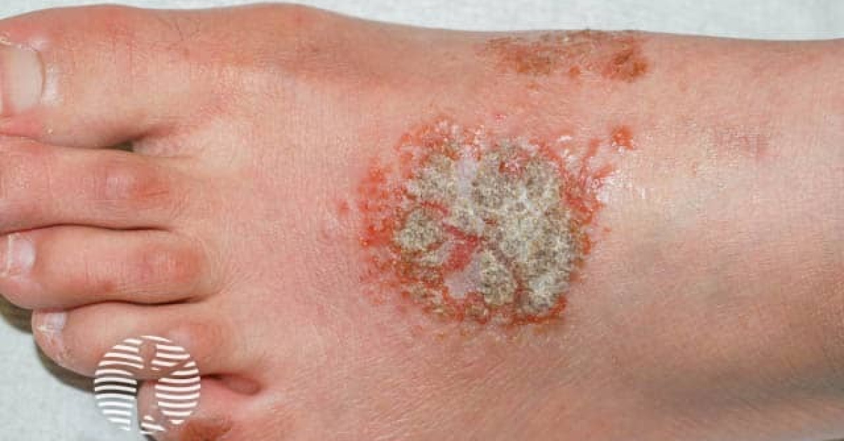 Clinical image of Discoid (nummular) eczema