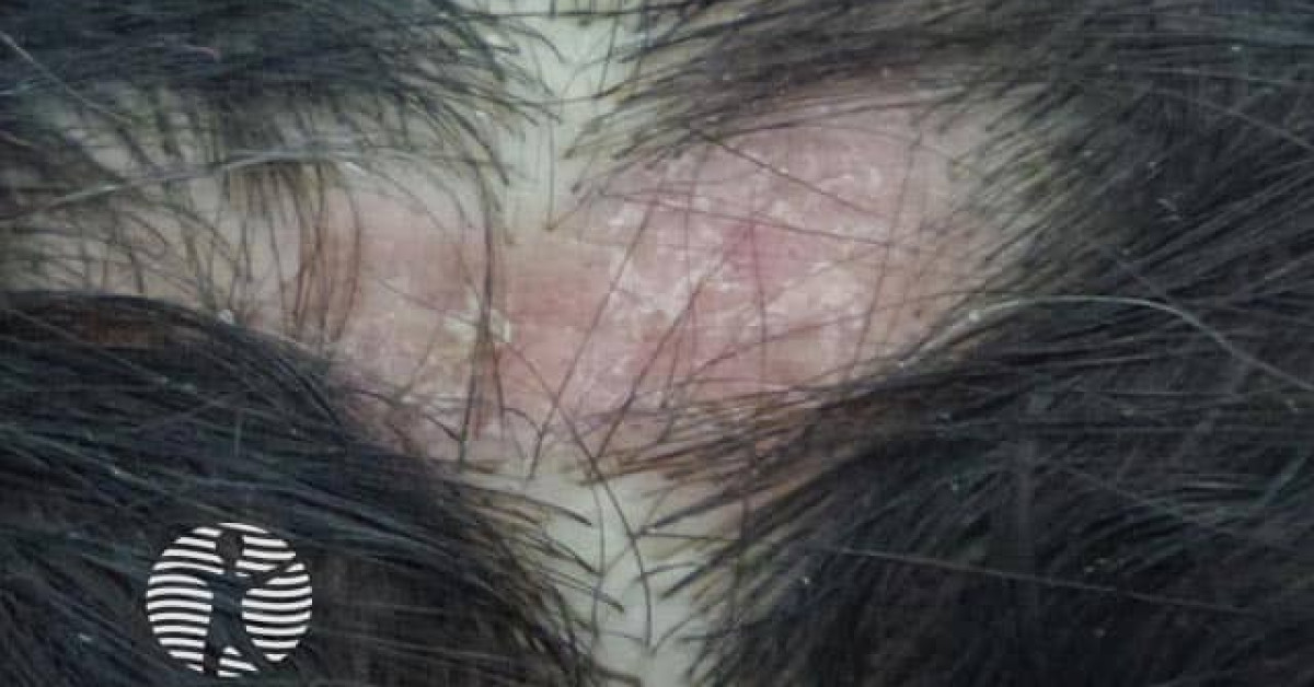 Clinical image of Discoid lupus erythematosus