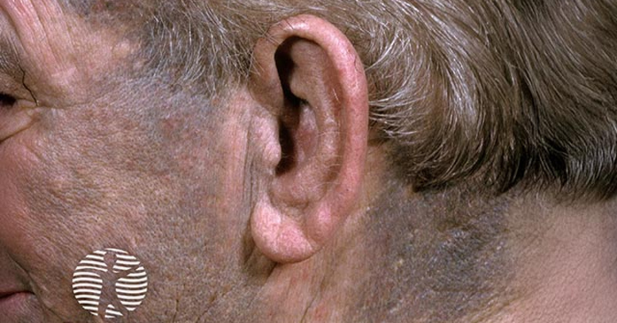 Clinical image of Drug-induced hyperpigmentation