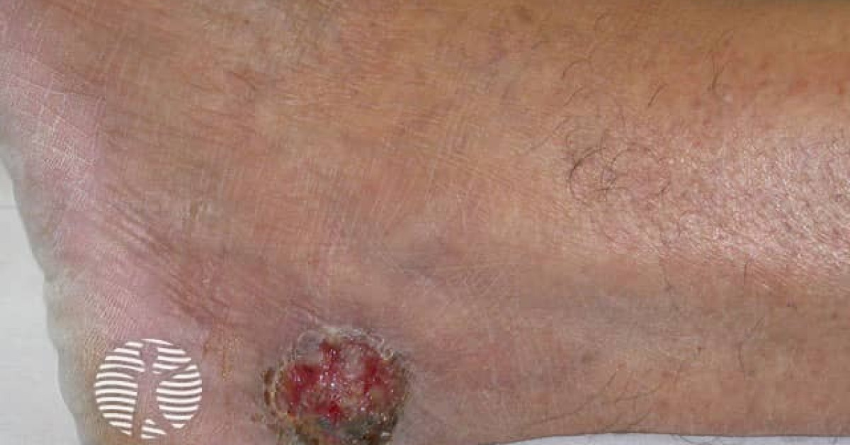 Clinical image of Eccrine porocarcinoma