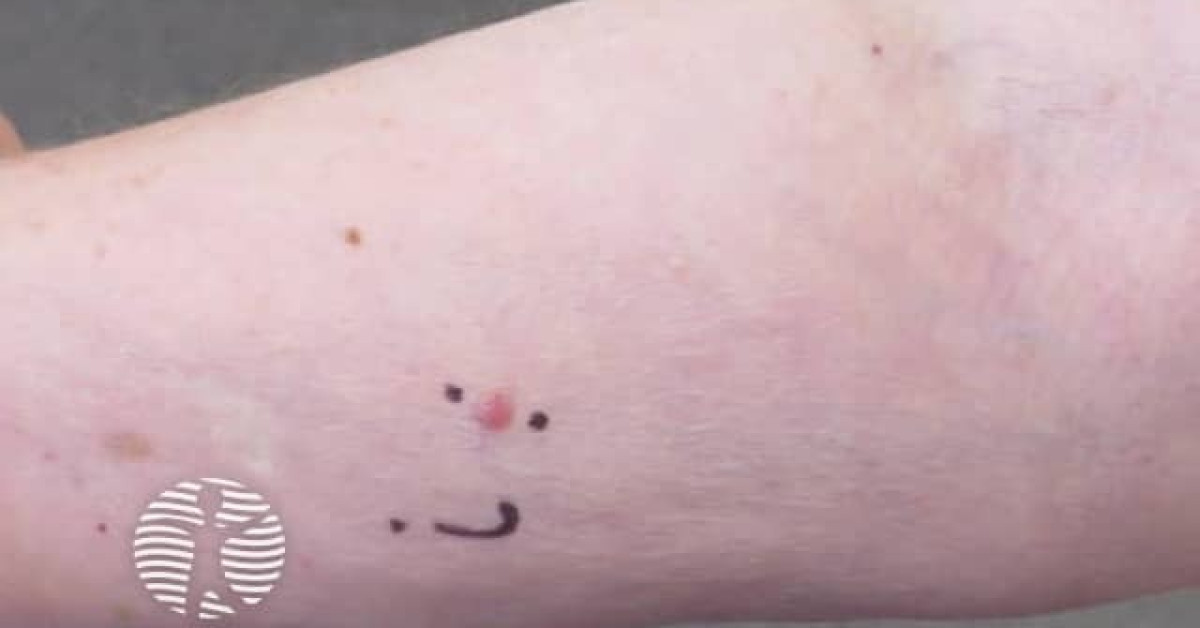 Clinical image of Eccrine poroma