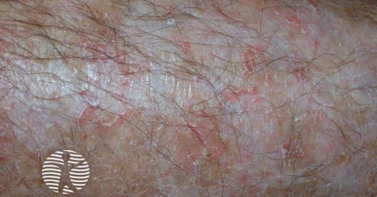 Clinical image of Eczema craquelé (asteatotic eczema)