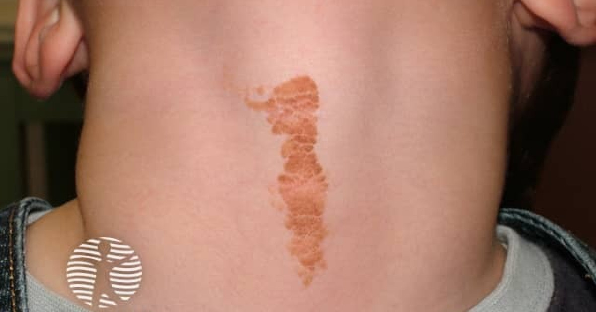 Clinical image of Epidermal naevus