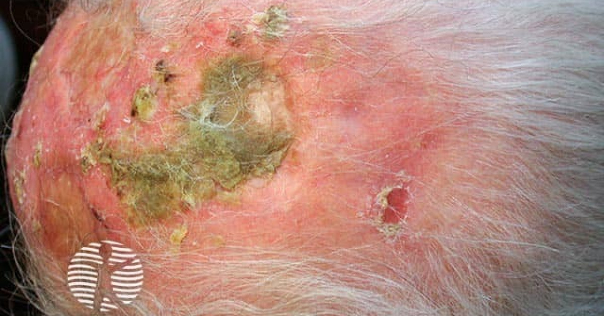 Clinical image of Erosive pustular dermatosis of the scalp