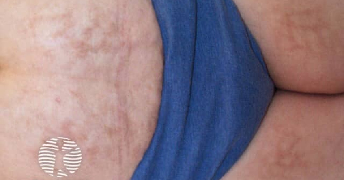 Clinical image of Erythema ab igne