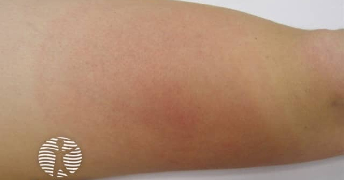 Clinical image of Erythema migrans (early Lyme)