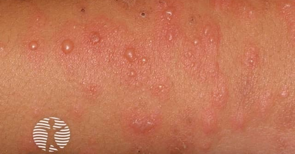 Clinical image of Erythema multiforme
