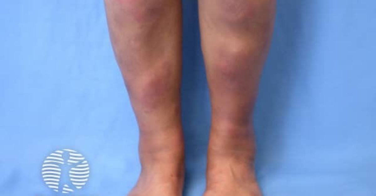 Clinical image of Erythema nodosum