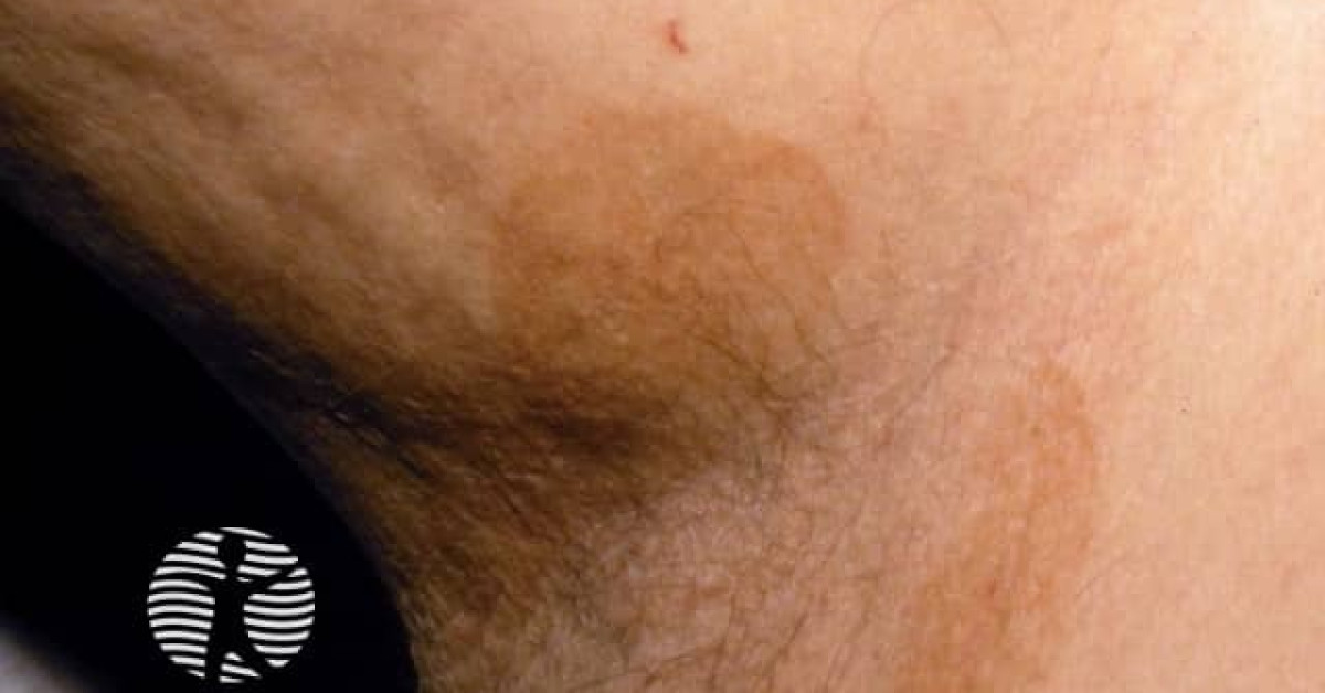 Clinical image of Erythrasma