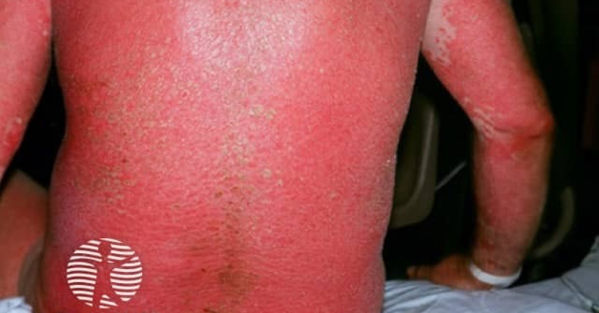 Clinical image of Erythroderma
