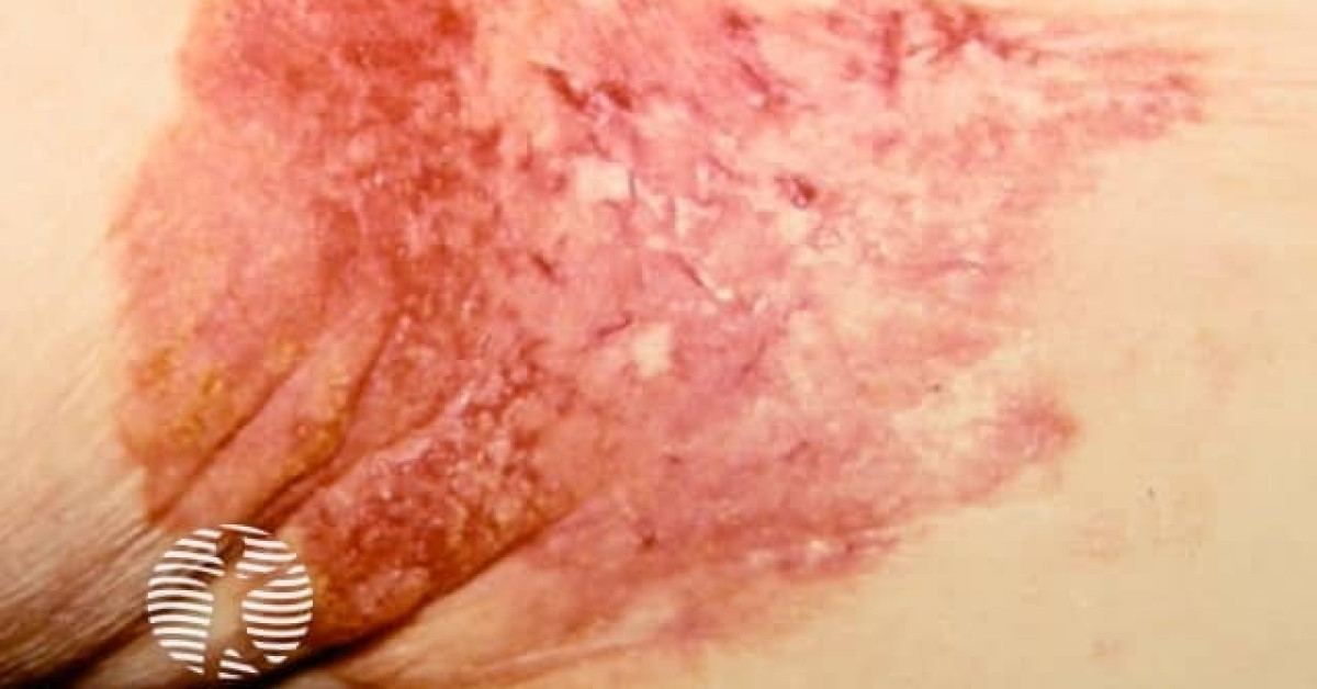 Clinical image of Extramammary Paget's disease