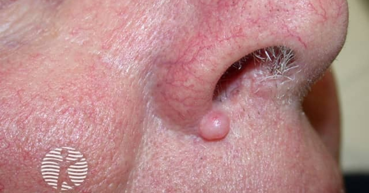 Clinical image of Fibrous papule of the face