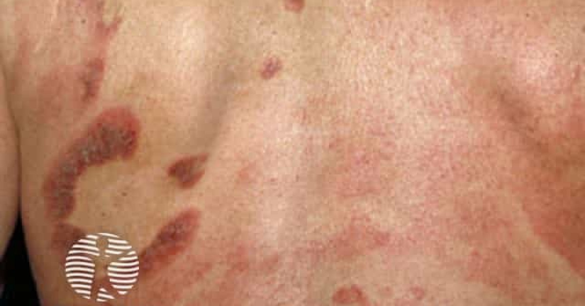 Clinical image of Folliculotropic mycosis fungoides