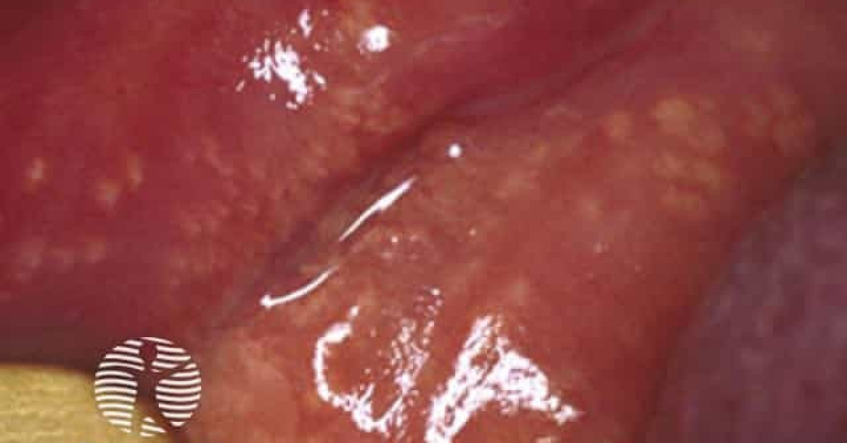 Clinical image of Fordyce spots