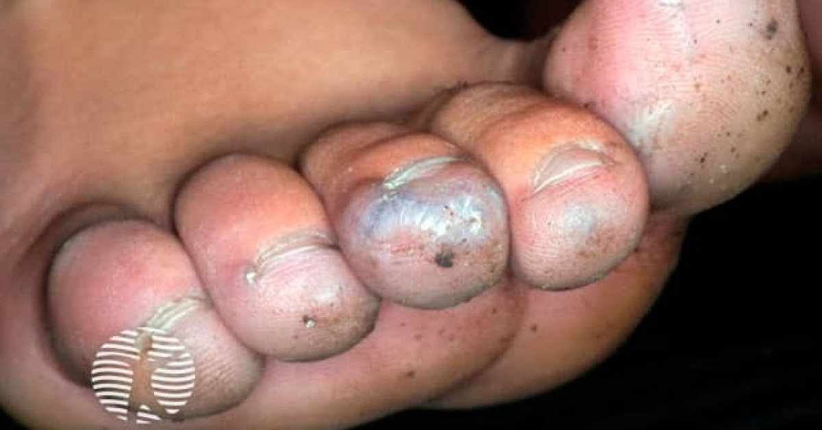 Clinical image of Glomus tumour
