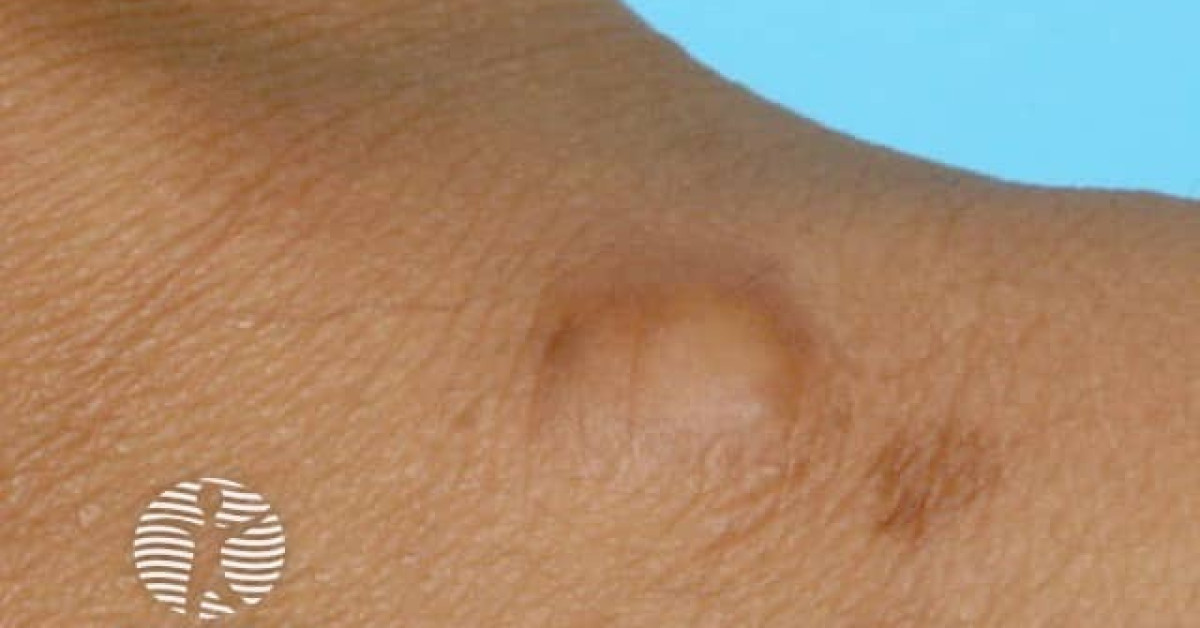 Clinical image of Granular cell tumour