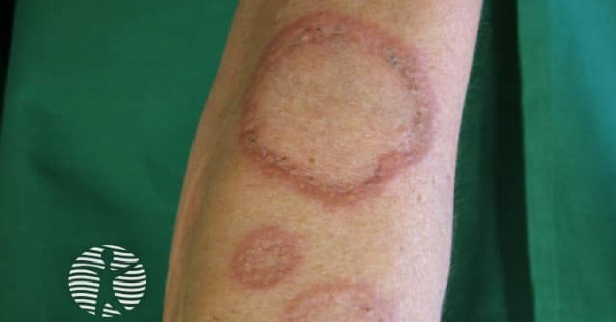 Clinical image of Granuloma annulare