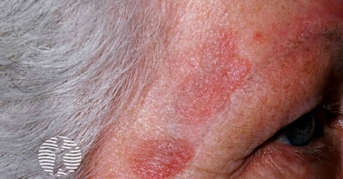 Clinical image of Granuloma faciale