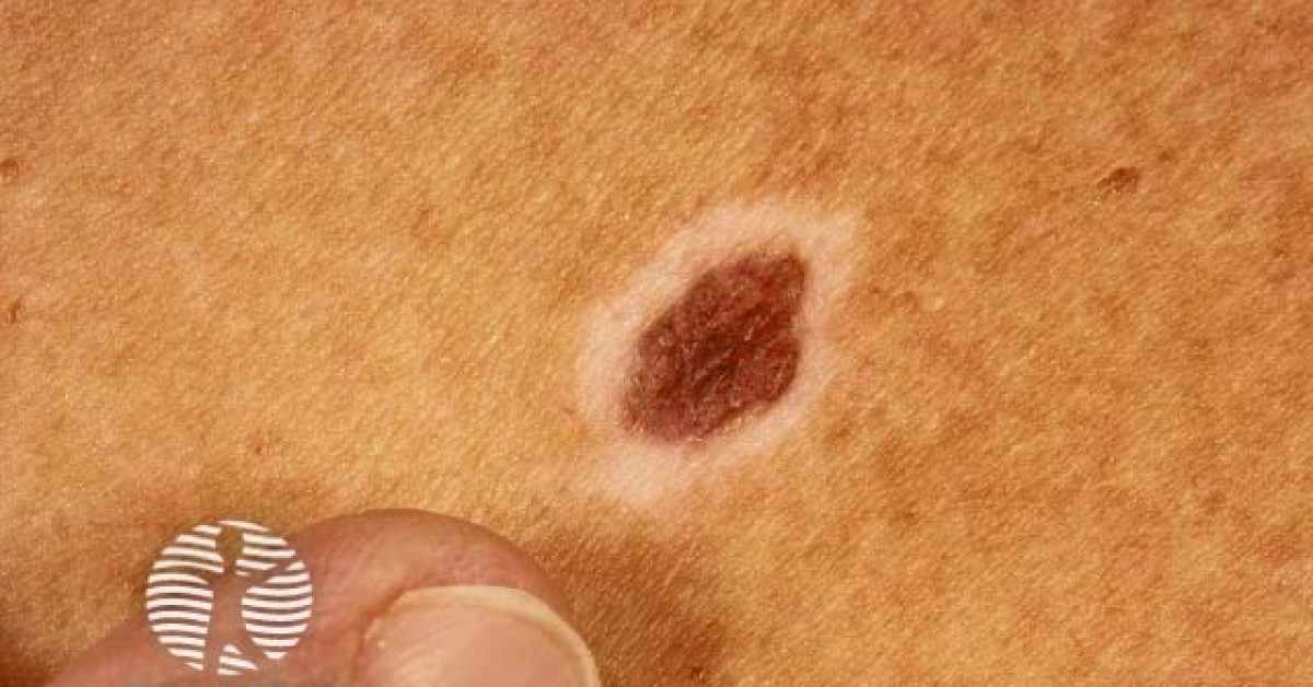 Clinical image of Halo naevus (Sutton)