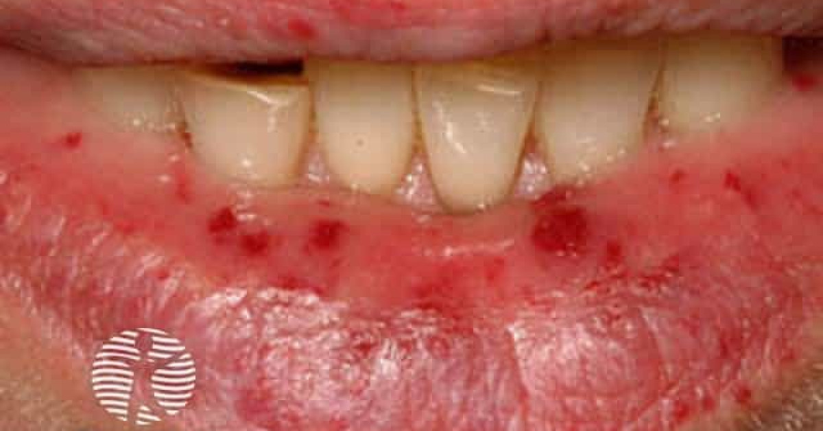 Clinical image of Hereditary haemorrhagic telangiectasia