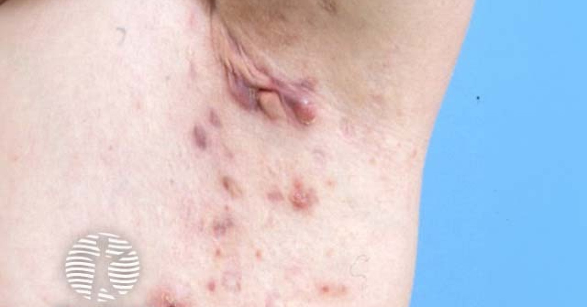 Clinical image of Hidradenitis suppurativa