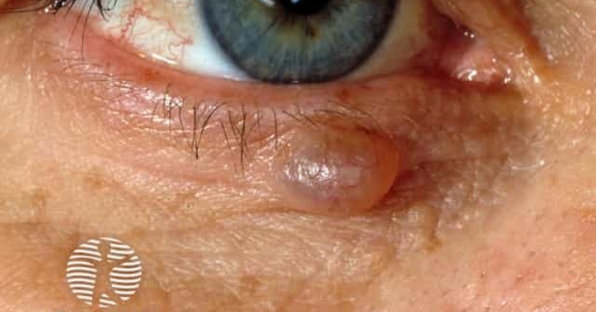 Clinical image of Hidrocystoma