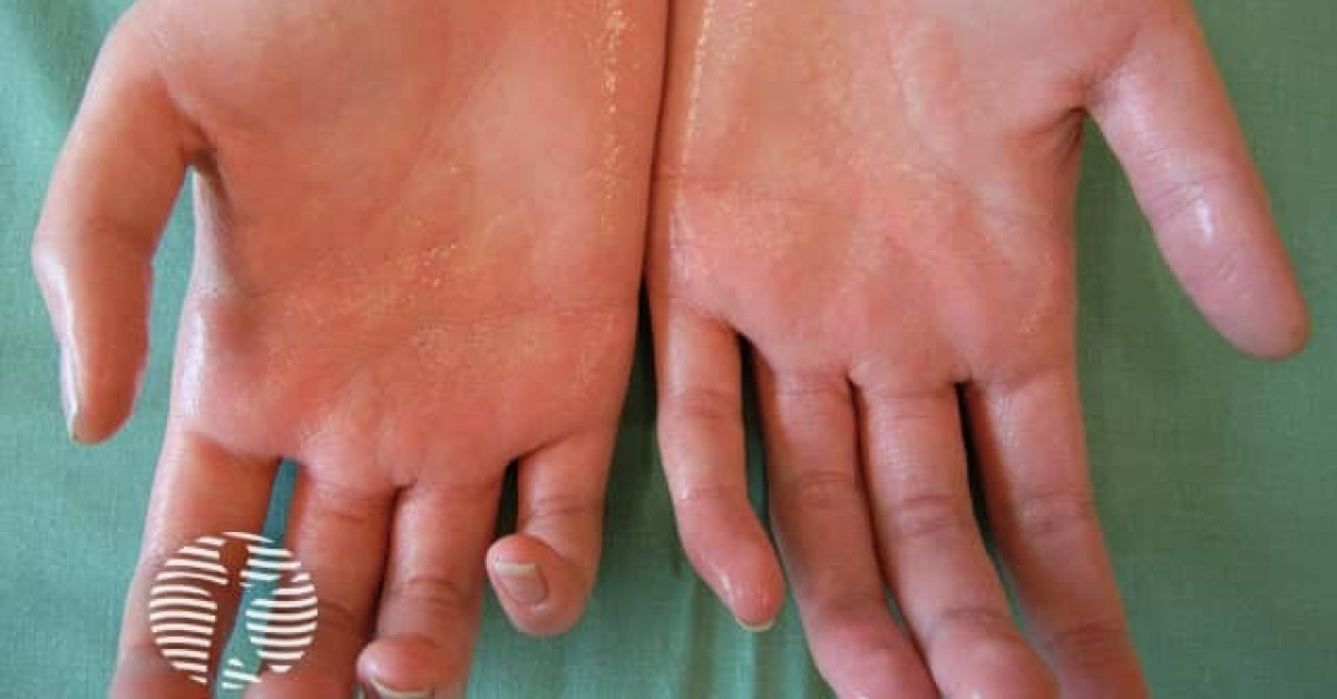 Clinical image of Hyperhidrosis