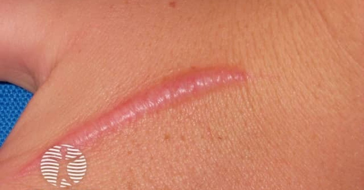 Clinical image of Hypertrophic scar
