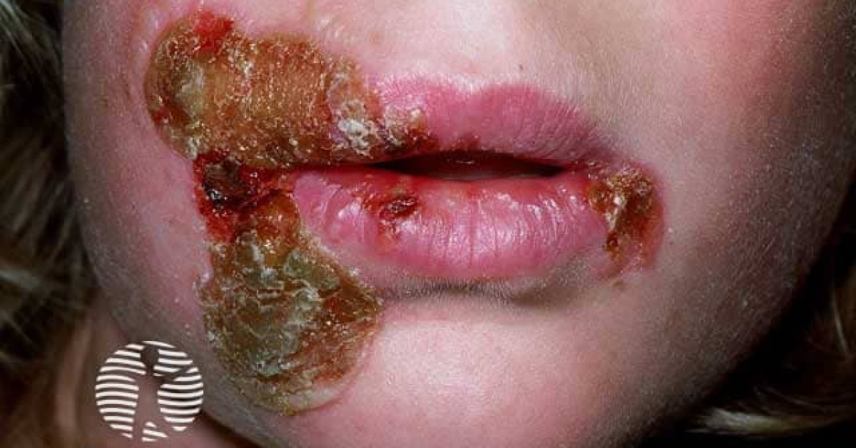 Clinical image of Impetigo