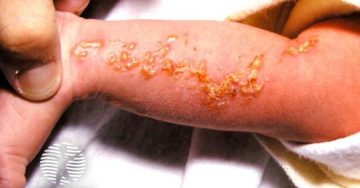 Clinical image of Incontinentia pigmenti