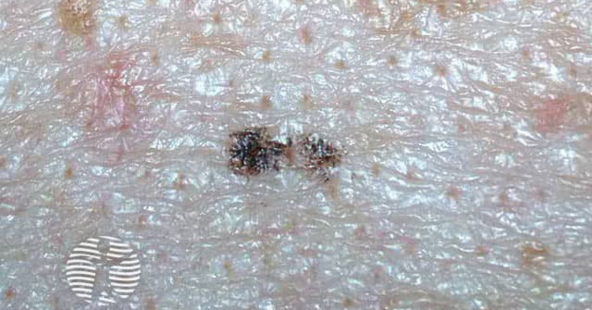 Clinical image of Ink-spot lentigo
