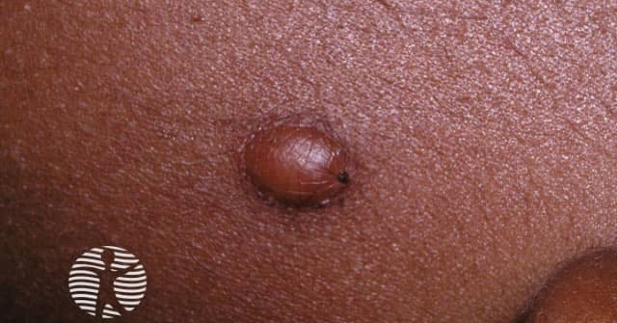 Clinical image of Juvenile xanthogranuloma